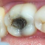 Проблемы с зубами при пульпите: методы лечения